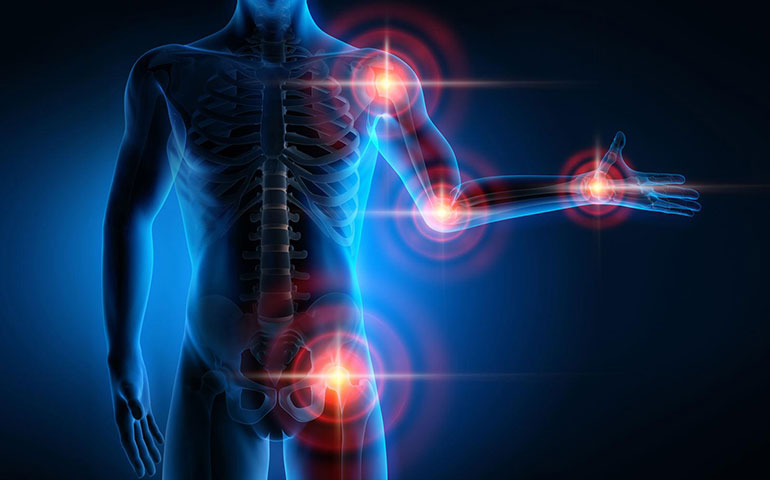 درمان طبیعی آرتروز