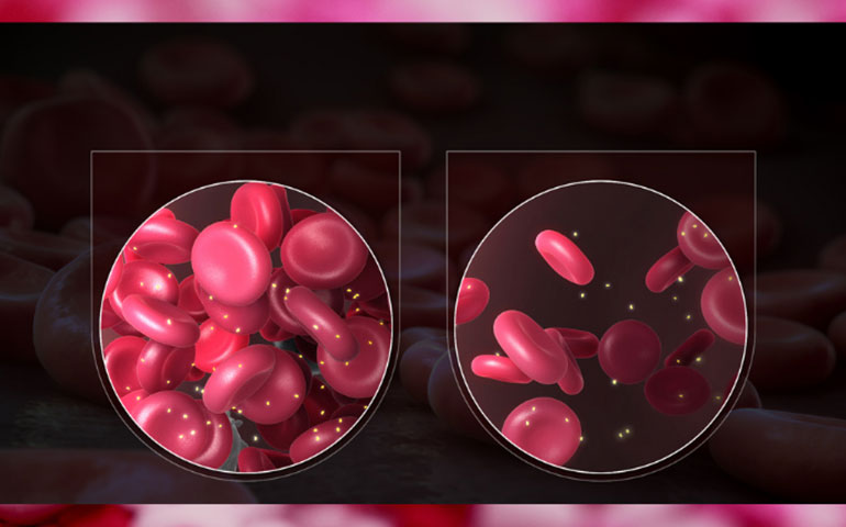 سوء تغذیه، فقر آهن و کم خونی به بار می آورد