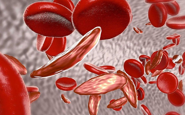 تفاوت کم خونی تالاسمی مینور با کم خونی فقر آهن