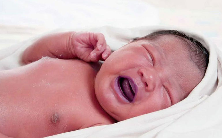سیانوز در نوزادان
